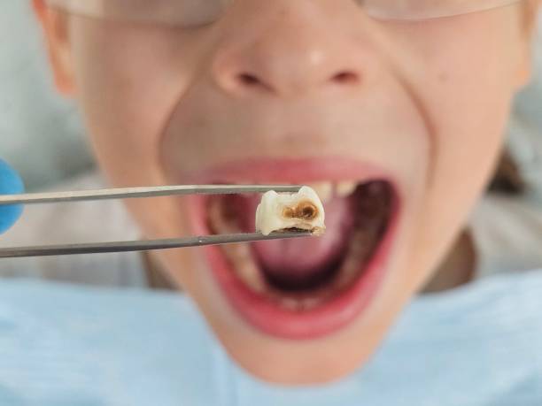 Best Emergency Dentist for Lost Fillings or Crowns in Upper Brookville, NY